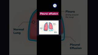 Pleural effusion Xray chest PAtypes of fluidetiology [upl. by Annekcm]