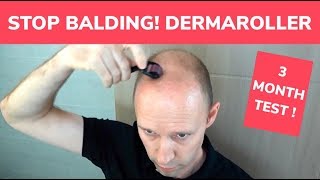 STOP BALDING  Dermaroller 3 Month Test and Tutorial [upl. by Anigar]