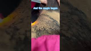 Laser treatment of hyperpigmentation skincare skintreatment viral skincaretips beautytips [upl. by Amelia]