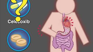 Cardiovascular Safety of Celecoxib  NEJM [upl. by Mya]