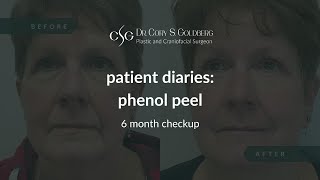 Patient Diaries Phenol Peel 6 month followup [upl. by Harrus]