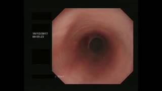 ENDOSCOPY IN PATIENT WITH ROUXENY GASTRIC BYPASS [upl. by Donall]