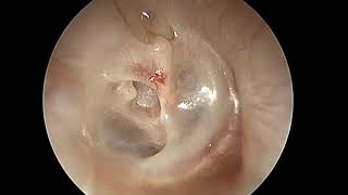 Endoscopic tympanoplasty with ossiculoplasty [upl. by Gillett]