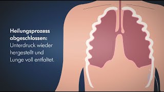 Wie funktioniert eine Thoraxdrainage und wie verhilft sie zur Regeneration der Lunge nach einer OP [upl. by Christoffer]