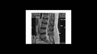 Degenerative disk disease progression over time [upl. by Nanahs]