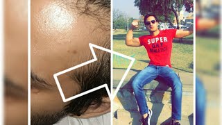 FINAX finasteride 304 दिनDays of usageBefore AfterReview Watch till the end Hindi [upl. by Gertrud]