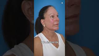 Stunning 6Month Preservation Facelift Transformation [upl. by Gabriell]