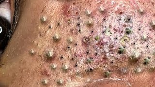 Big Cystic Acne Blackheads Extraction Blackheads amp Milia Whiteheads Removal Pimple Popping  1036 [upl. by Enyehc]