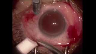 Vitrectomie pelage pour membrane epimaculaire  Vitrectomy for epiretinal membrane [upl. by Carnay]