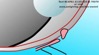 Jasper Corneal Sequestrum [upl. by Aicrag]