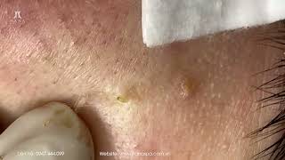 Big Cystic Acne Blackheads Extraction Blackheads amp Milia Whiteheads Removal Pimple Popping [upl. by Dragde983]