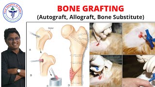 BONE GRAFTING  Lecture 05  Orthopedics [upl. by Anaeel]