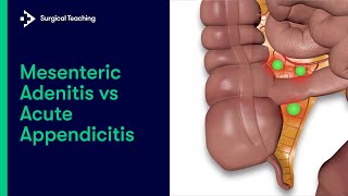 Mesenteric Adenitis vs Appendicitis  How to tell the difference [upl. by Zenas]