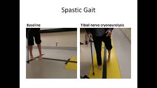 Multimodal treatment of spastic equinovarus foot [upl. by Cathe]