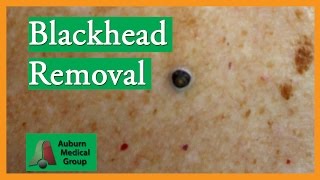 Blackhead Removal without Extractor Tool Edited  Auburn Medical Group [upl. by Aihseken]