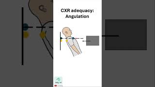 Chest xray adequacy ANGULATION [upl. by Efrem]