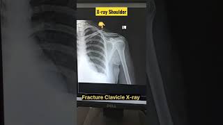 Clavicle Fracture Xray  Xray Shoulder shorts radiography fracture radiology xray clavicle [upl. by Lateh908]