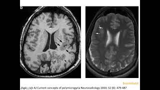 9 Polymicrogyria PMG cortical malformation post migratory glial limiting membrane neuroimaging [upl. by Ellehsat]