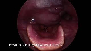 Pharyngeal wall Tumor [upl. by Onin833]