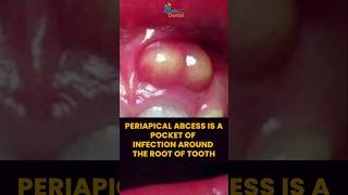 Periapical Abscess  Symptoms Treatment Options amp When to See a Dentist  Apollo Dental [upl. by Alleacim]