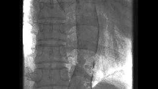 Dense Calcification in the Aorta [upl. by Anivlac]