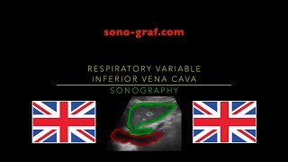 Sonography  Respiratory Variable Inferior Vena Cava [upl. by Wertheimer]