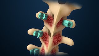 Scoliosis  Scoliosis Surgery  Nucleus Health [upl. by Qidas]