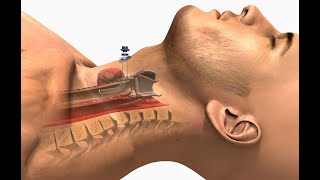 tracheostomy selflessmedicose CompleteAnatomyElsevier [upl. by Mccallion]