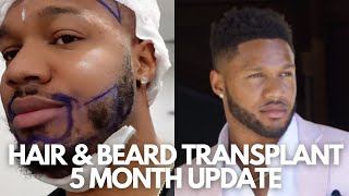 HAIR AND BEARD TRANSPLANT UPDATE AND BURNING QUESTIONS ASLI TARCAN CLINIC TURKEY  BLACK HAIR [upl. by Chrisse]