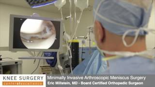 Arthroscopic Knee Surgery  Meniscus Surgery Performed by Dr Millstein [upl. by Amando]