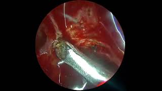 Anterior ethmoidal artery leak by prof dr jaskaran singh [upl. by Acsehcnarf430]