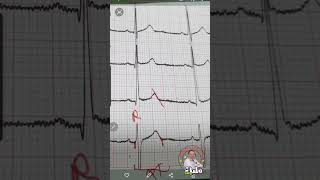 How to calculate QTc in esconds Dr Alaa Nasr [upl. by Halyak]