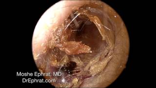 Ear Wax Removal [upl. by Ruskin]