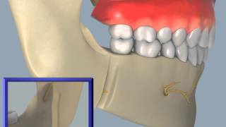 Sagittal Split Osteotomy [upl. by Prochoras]