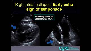 Pericardial Tamponade Echo [upl. by Pellegrini872]