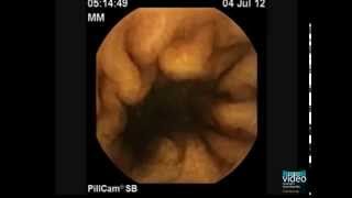 The PillCam Detection of Meckels Diverticulum [upl. by Nylannej]