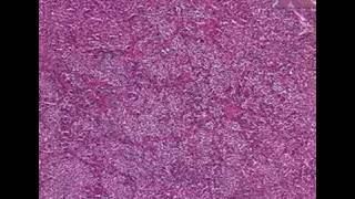 Histopathology PituitaryAcidophilic adenoma [upl. by Till]