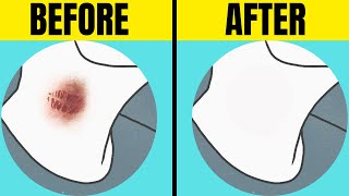 HOW to GET RID of Hickeys PROVEN Removal Techniques [upl. by Arries152]