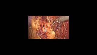 Laparoscopic Nephrectomy by Dr Negi [upl. by Fidelia]