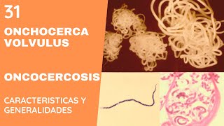 ONCHOCERCA 31  ONCOCERCOSIS  NEMATODOS [upl. by Bozuwa]