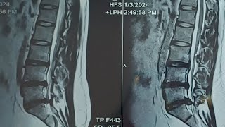 Always be happy L4 L5 S1 Disc bulgeDisc decompression lower back surgery Disc Break after surgery [upl. by Ardnoek]