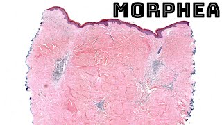 Morphea under the microscope localized scleroderma skin disease histology pathology dermatology [upl. by Roselle63]