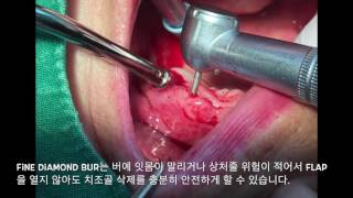 Bur selection tip For alveolopasty and osteoplasty by 드림팩토리치과 [upl. by Bow]