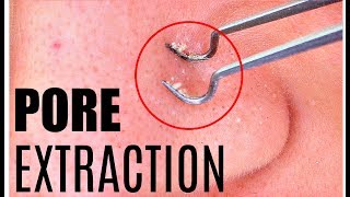 BLACKHEAD Removal  Extraction  How To POP a Pimple by Golani [upl. by Macintyre270]