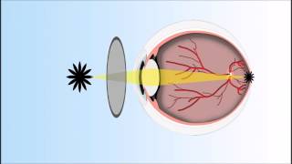 Presbyopia Explained Annimated Video [upl. by Annovad]