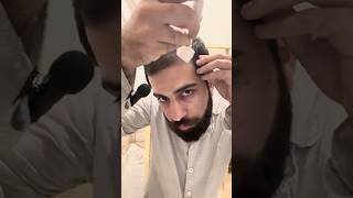 Hair Restoration day40 by Derma Stamp minoxidil haircare [upl. by Klump584]