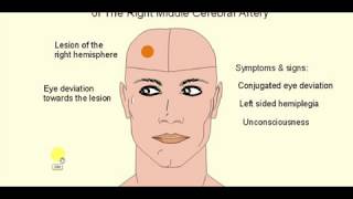 MEDICINE LECTURES  Neurology  STROKE  Part 2 [upl. by Ellesig]