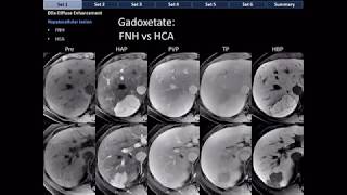 CT Differential Diagnosis of Focal Hepatic Lesions Basic Radiology [upl. by Brosine]