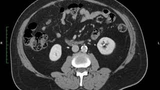 Ct Urogram Venous [upl. by Evyn348]