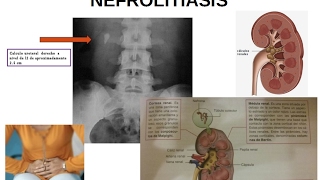 FISIOPATOLOGÍA URINARIA Litiasis renal o nefrolitiasis piedras en el riñón [upl. by Penthea]